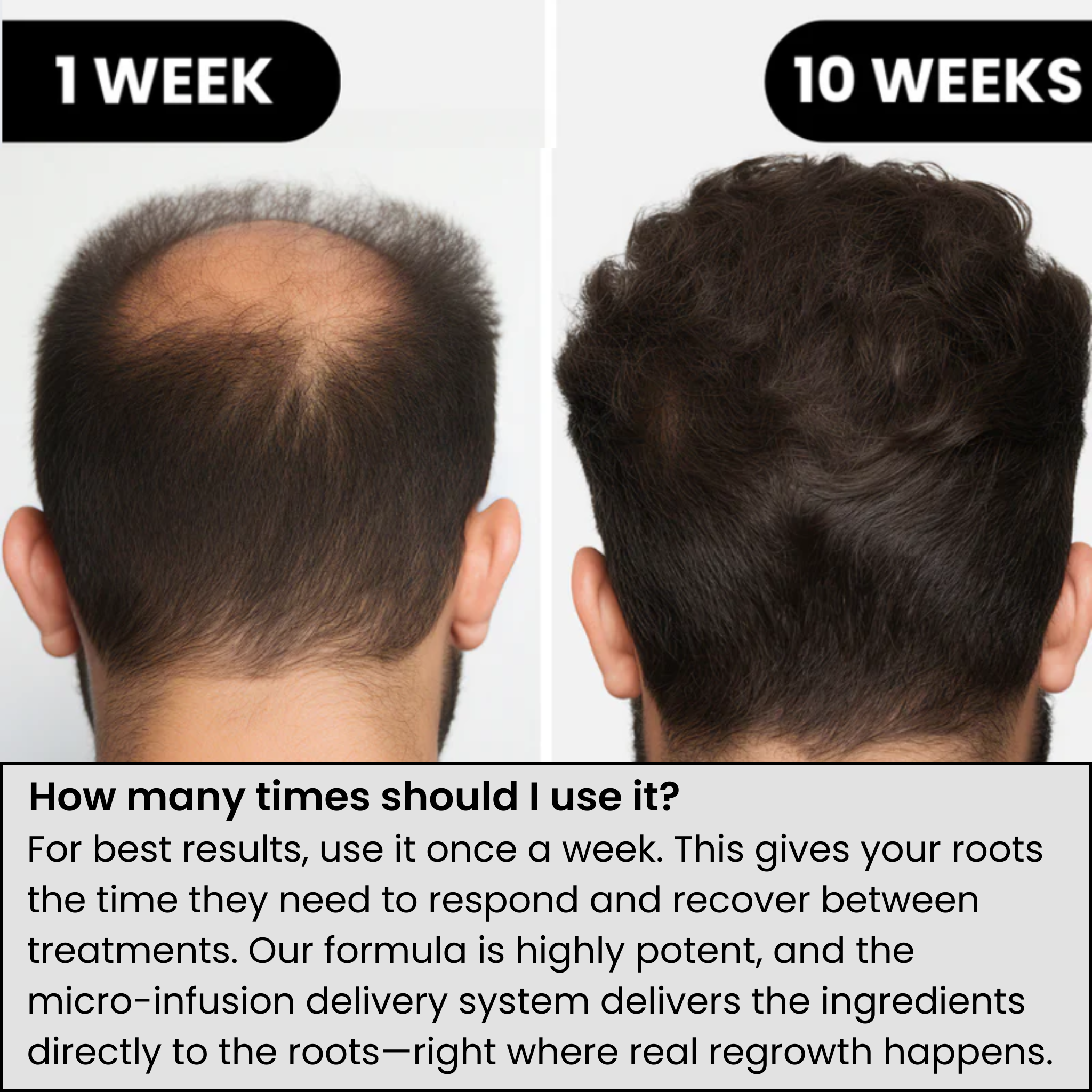 AlphaInfuse™ Hair Regrowth System